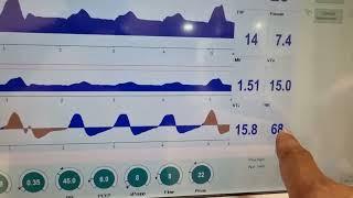 When to extubate ICU patients ,