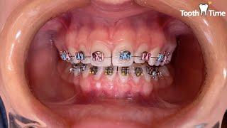 How they put braces on - 15 years old patient - Tooth Time Family Dentistry New Braunfels Texas