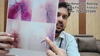 World Best Treatment For Fistula In Ano - Ksharsutra Vidhi. mo/wp 7267925989