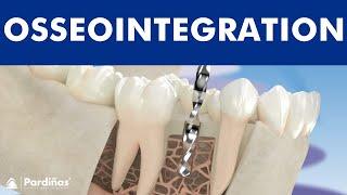 How does an implant work? Osseointegration of dental implants ©