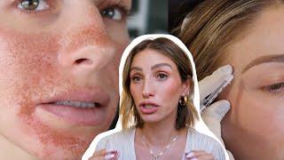 THE TRUTH BEHIND MY FACE | Botox, Fillers, Laser