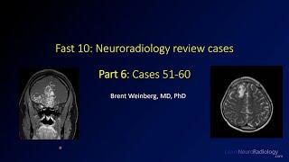 Fast 10: Neuroradiology high speed case review part 6 - Cases 51-60