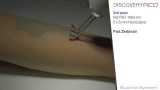 Quanta Discovery Pico Laser, tattoo removal Treatment