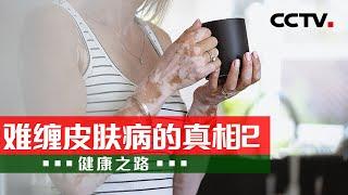 这病能治！好心情是治疗白癜风的“良药” 20240328 难缠皮肤病的真相2 |《健康之路》CCTV科教