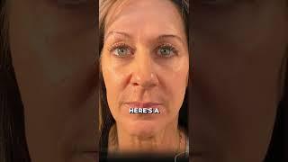 DEEP NASOLABIAL FOLDS ?? Do THIS....