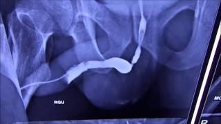 Retrograde Urography (RGU) for diagnosis of Urethral Stricture