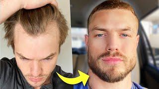 Shaving My Head 2 Years After Hair Transplant