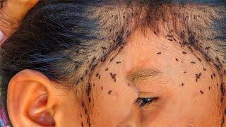 The SHOCKING Truth About Scalp Check for lice remove