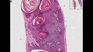 Histopathology Skin-- Seborrheic keratosis