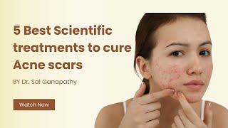 5 Scientific Treatments to Cure Acne Scars | #viral #skintreatment #acnetreatment