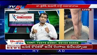 Varicose Vein Treatment | Citi Vascular Centre Dr.Shailesh Kumar | Hyderabad | TV5 News