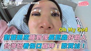 【割雙眼皮腫到像長巨蟲好嚇人 台灣妞看傷口直呼：歐買尬！】｜@highaday