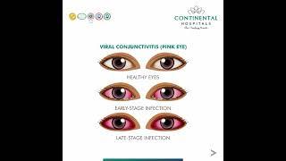 Conjunctivitis: What Is Pink Eye? | Continental Hospitals #pinkeye #conjunctivitis