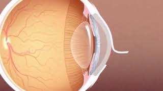 LASIK eye surgery