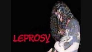 Leprosy - Cirrhosis