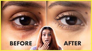 Remove Dark Circles Under Eyes Naturally At Home! Every Dark Circle Remedy | Glamrs