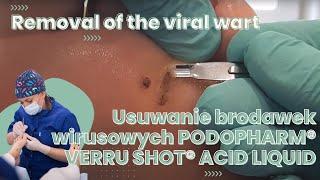 Removal of the viral wart / Usuwanie brodawek wirusowych PODOPHARM® VERRU SHOT®  ACID LIQUID