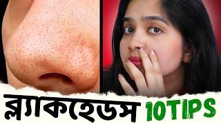  BLACKHEADS / ব্ল্যাকহেডস দূর করার ১০টি বৈজ্ঞানিক উপায় । টিনএজ - এডালট সবার জন্য রুটিন