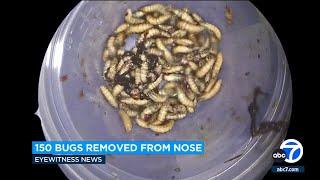 150 bugs removed from Florida man's nose