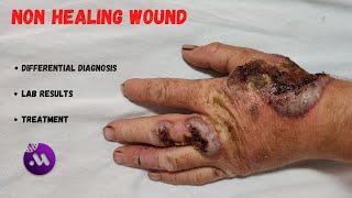 Non healing hand wound | How to heal?