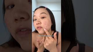 F*ck the hormones  #acne #relatable #clearskin #hormonalacne