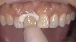 How to Use Kerr Nexus RMGI Resin Modified Glass Ionomer Cement