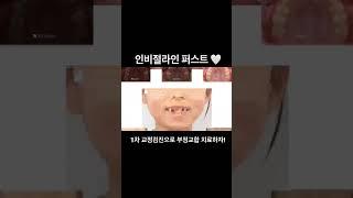 빠르고 효과적인 혼합치열기 치아교정 
