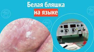  Белая бляшка на языке. Клинический случай №1303