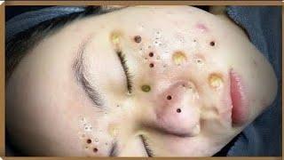 blackheads acne treatment blackheads new 2023 today blackheads new this week