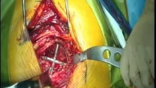 Total Hip Replacement Surgery - MedStar Union Memorial Hospital