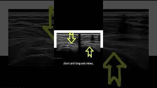 #ultrasound Guided Interventions: Cases (Trochanteric Bursitis Injection)