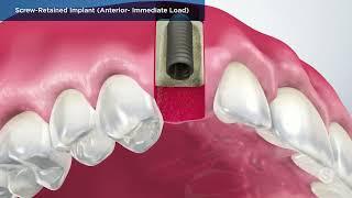 DENTAL IMPLANTS IN CHICAGO