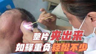 东方ASMR 大舅首次体验专业采耳！货还真不少 整片镊出来感觉难以形容