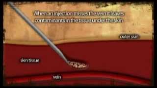 AIVL Vein Care Guide Abscess Formation Animation