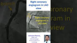Right coronary angiogram in LAO view