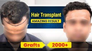 Best Hair Transplant in India | Amazing Hair Transplant Results & Cost of Hair Transplant in India