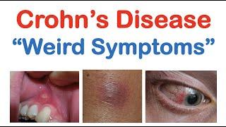 Crohn’s Disease Weird Symptoms | Atypical Clinical Features | Skin, Mouth, Joints, Organ Systems