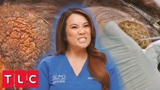 Dr. Lee Removes Spongy, Brainlike Bump on Patient's Head | Dr. Pimple Popper