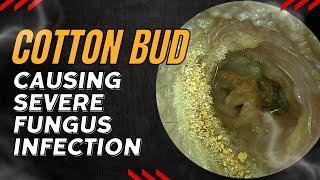 Cotton Bud Causing SEVERE Fungus Infection 