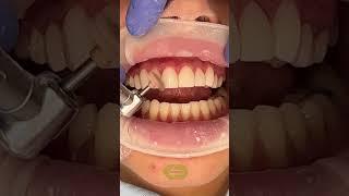 Cosmetic Dentistry in 30 Seconds #shorts