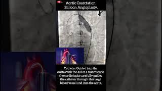 #cathlab #assessment #aorta #Angioplasty #nursing - Coarctation of the Aorta (CoA)