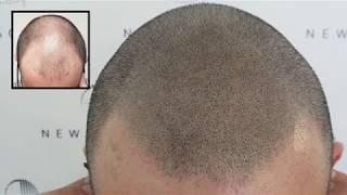 Natural scalp micro pigmentation capillaire results - Montreal - Laval - Canada