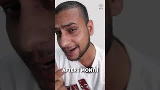 YouTuber Mehtab Saifi Hair Transplant Result After 3.5 Months#shorts #viralvideo