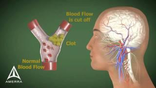 Stroke - 3D Medical Animation