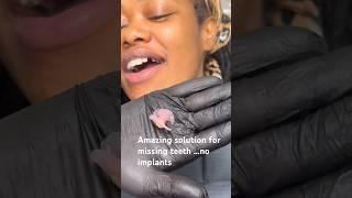 Amazing solution for missing teeth ! No implants and you can eat with it !