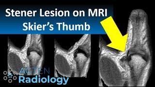 Stener Lesion (Skier's Thumb) on MRI