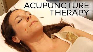 Acupuncture Therapy to Relieve Stress and Sinus Issues | ASMR Triggers