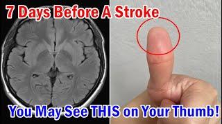 Doctors warn! 7 Days Before A Stroke, You May See THIS on Your Thumb! Do Not Ignore it!