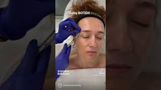 Baby Botox BTX Allergan Vistabel