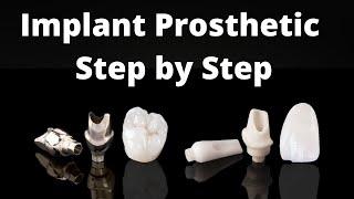 Dental Implant prosthetic procedure- Open tray impression coping technique, Jig verification, Crown